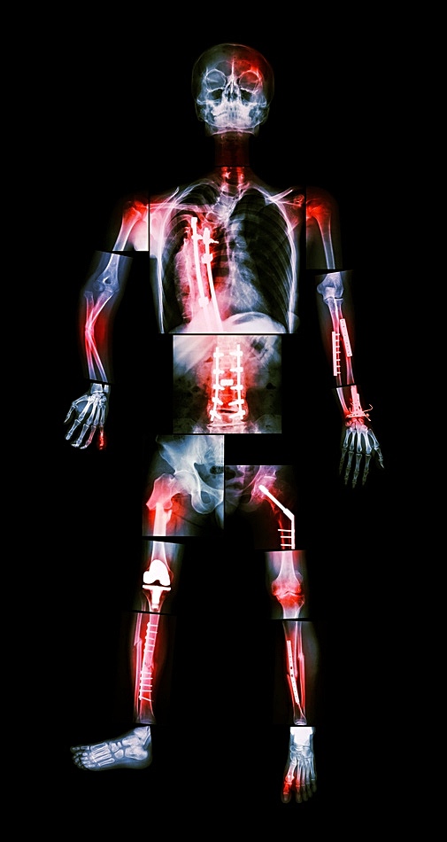 X-ray whole body and multiple fracture