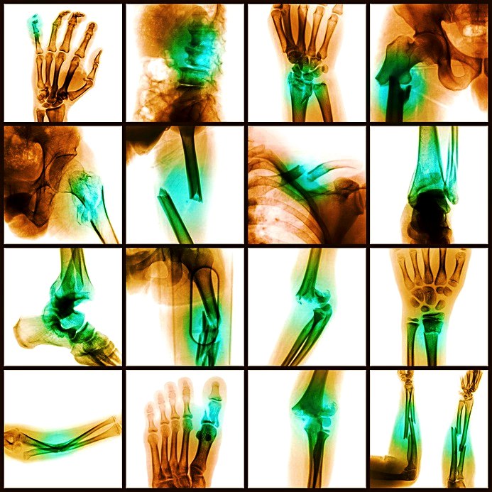 Collection X-ray multiple bone fracture